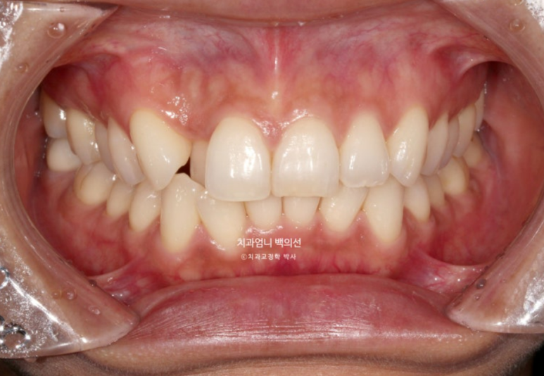 인비절라인 비발치 덧니 교정 반대교합 치료 후기 관련 이미지 2