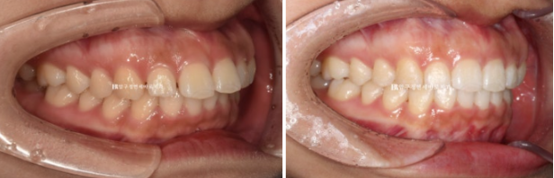 돌출입 교정 치아 벌어짐 인비절라인 투명교정 치료 관련 이미지 8