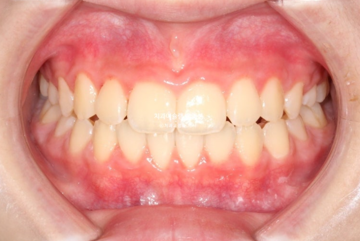 어린이 무턱 성장교정 덧니 인비절라인 퍼스트 악궁확장 치료기간 2년 관련 이미지 22