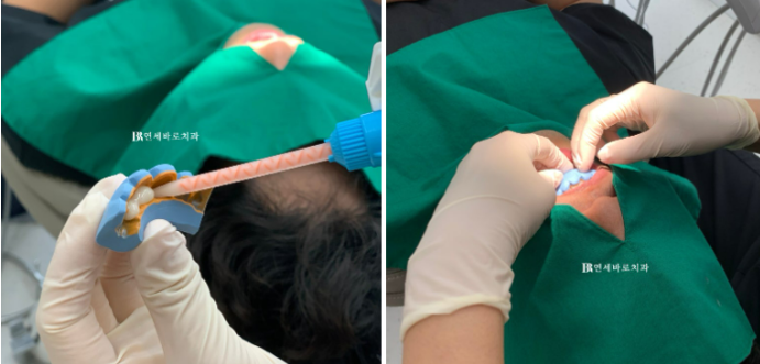 No-Prep Veneers Are Not the Right Treatment for Everyone image 4