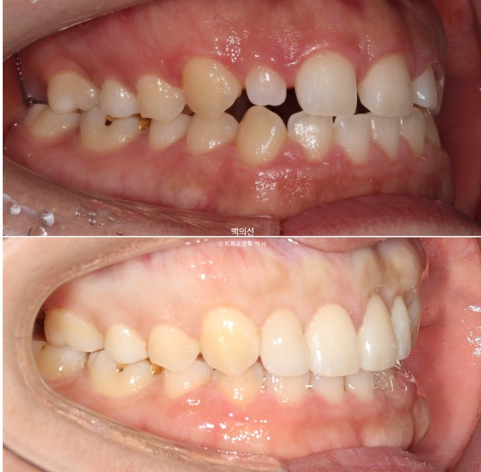 30대 치아교정 돌출입 교정 :: 잇몸미소 거미스마일 교정 입술부전증 결손치 무턱교정 관련 이미지 19