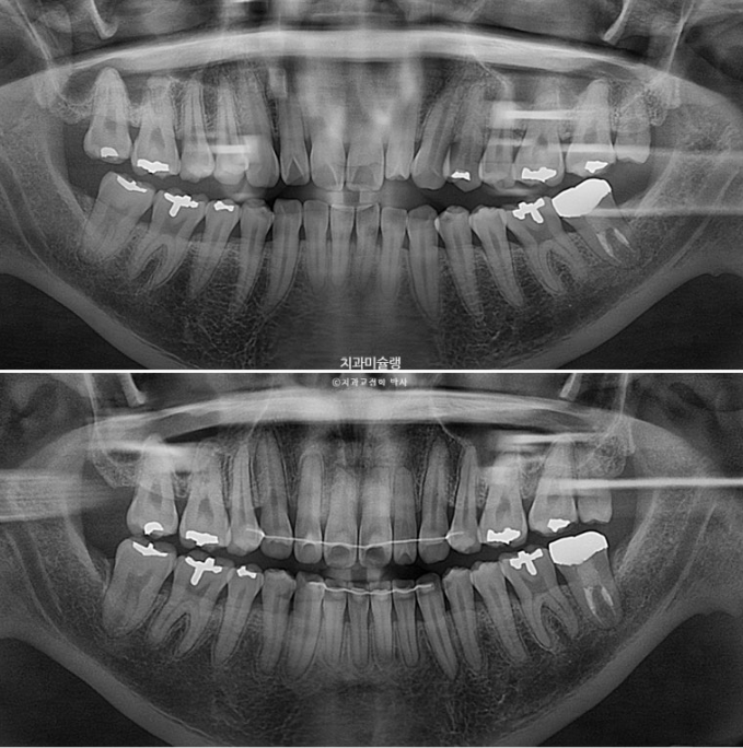 Extraction Orthodontics with Clippy-C for Protruding Mouth, Gum Smile, Gummy Smile Correction, and Treatment for a Recessed Chin image 24