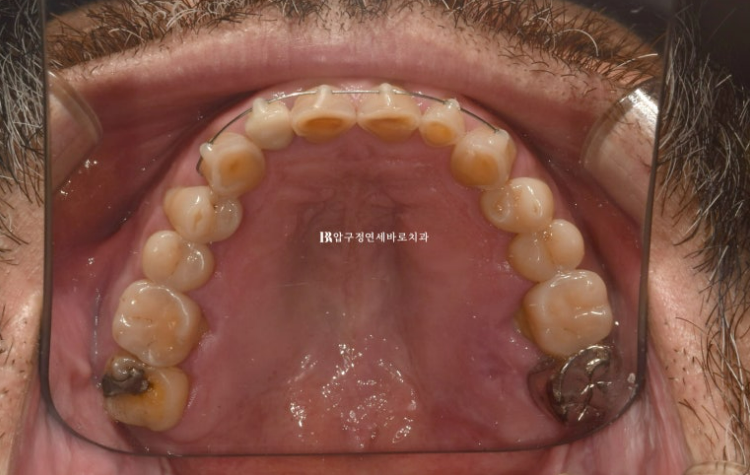 50대 중년교정 무삭제 라미네이트 중년 부분교정 후기 관련 이미지 6