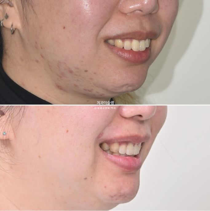 Extraction Orthodontics with Clippy-C for Protruding Mouth, Gum Smile, Gummy Smile Correction, and Treatment for a Recessed Chin image 21