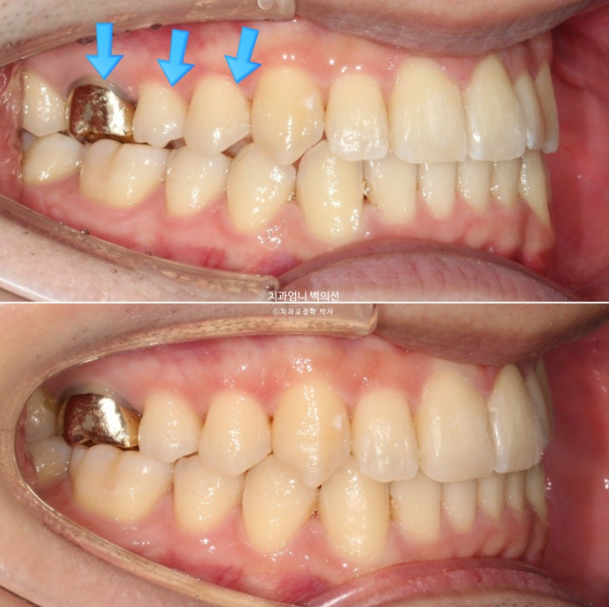 인비절라인 비발치 앞니 돌출 덧니 교정 ? 관련 이미지 12