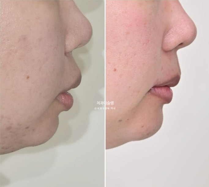 Extraction Orthodontics with Clippy-C for Protruding Mouth, Gum Smile, Gummy Smile Correction, and Treatment for a Recessed Chin image 22