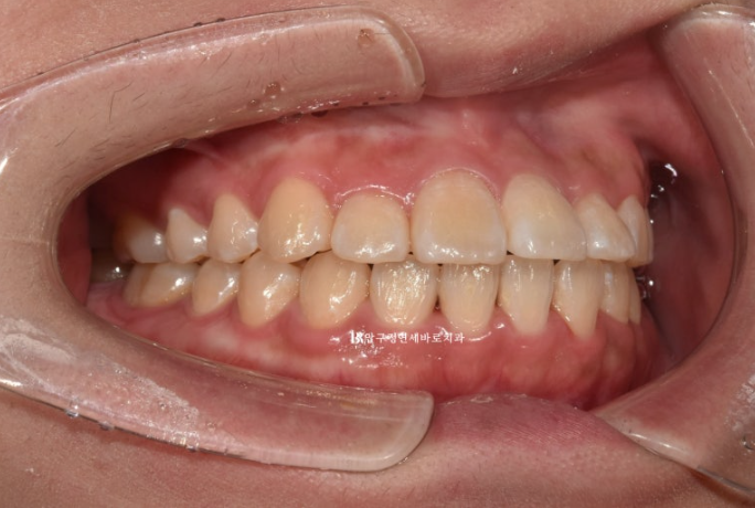 인비절라인라이트 재교정 뻐드렁니 교정 돌출 교정 관련 이미지 2