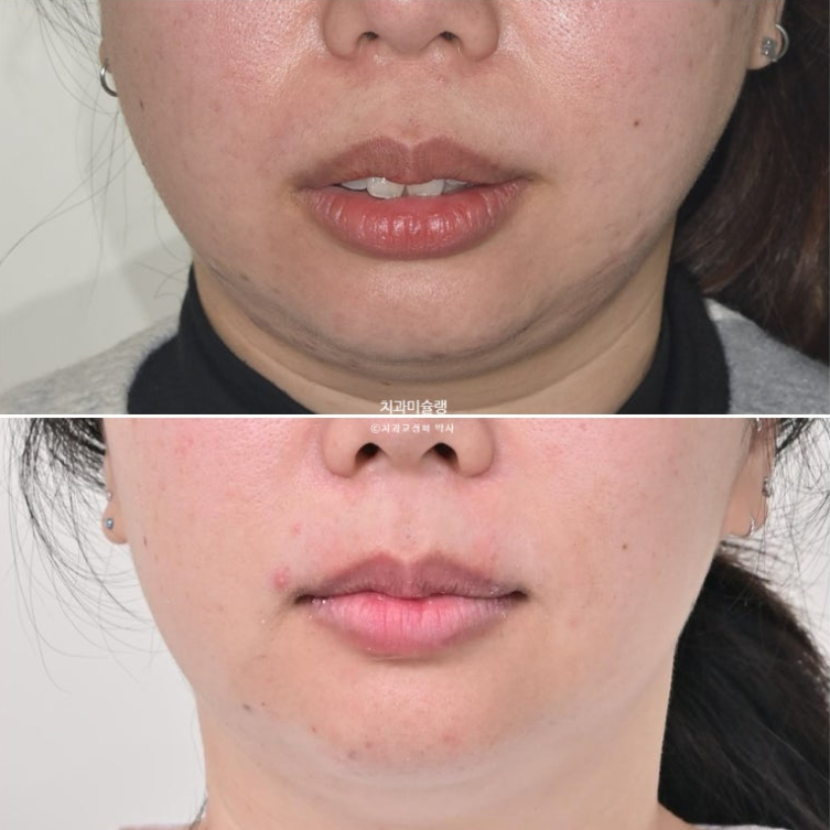 Extraction Orthodontics with Clippy-C for Protruding Mouth, Gum Smile, Gummy Smile Correction, and Treatment for a Recessed Chin image 17