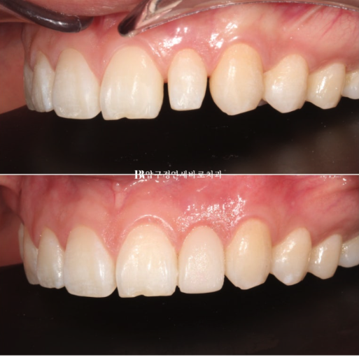 앞니 부분교정은 어떤 경우에 가능한가요? 단기 앞니 부분교정 왜소치 치료 무삭제 라미네이트 관련 이미지 7