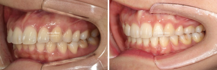 30대 돌출입 발치교정 입술부전증 치료 관련 이미지 15