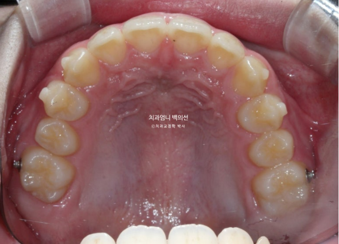어린이 투명교정 인비절라인 퍼스트 가위교합 돌출교정 덧니교정 관련 이미지 7