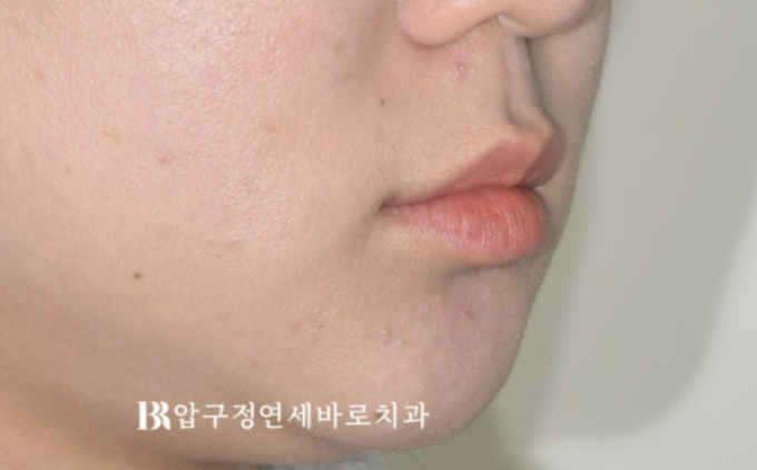 앞니 결손, 벌어진 치아 무삭제 라미네이트보다 먼저 해야 할 치료는? 관련 이미지 5