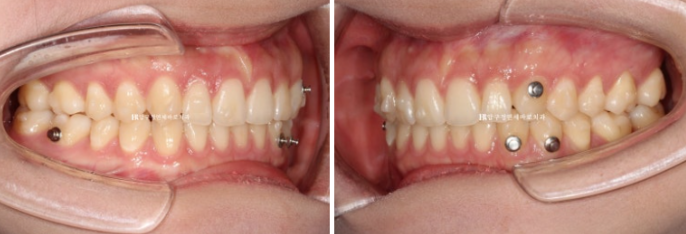 압구정 교정치과 / 옥니교정 인비절라인 라이트 덧니교정 관련 이미지 7
