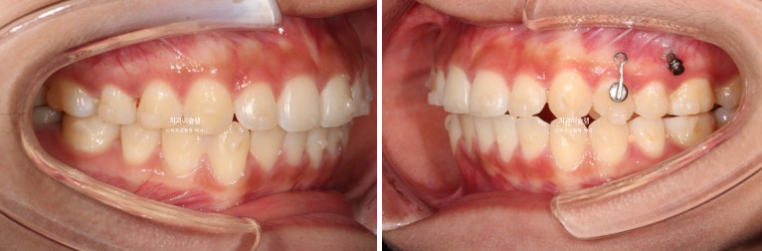 유학생 치아교정 해외거주 한국에서 치아교정? 관련 이미지 10