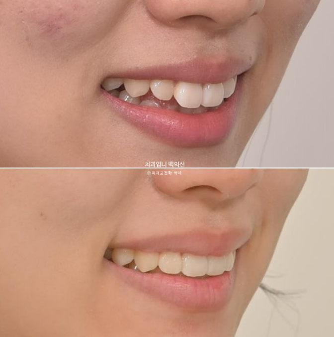 앞니 부분 교정 급속 교정 토끼이빨 MTA 미니튜브 치간삭제 치료기간 9개월 관련 이미지 18