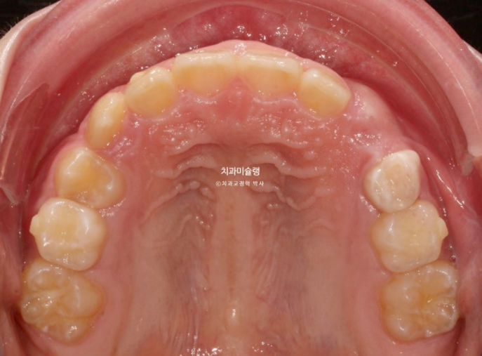 선천적 결손 잔존유치 과개교합 돌출입 인비절라인 퍼스트 어린이 투명교정 치료기간 관련 이미지 8