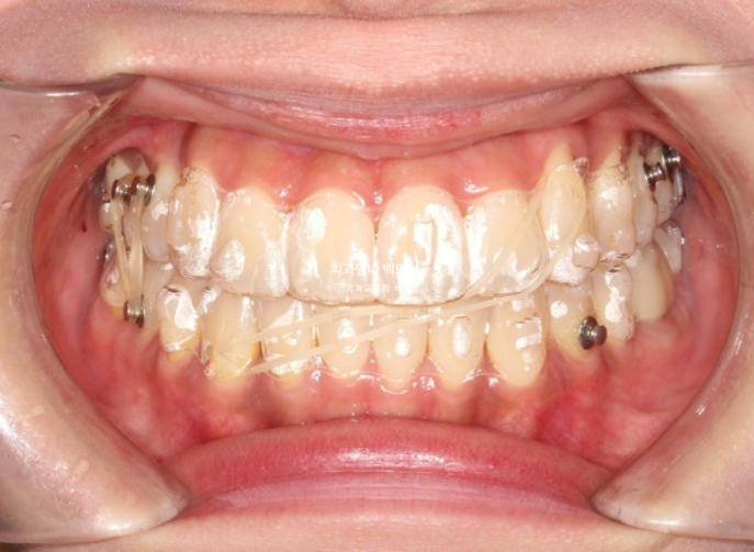 비발치 교정 덧니 인비절라인 교정 절단교합 반대교합 치료기간 1년 6개월 관련 이미지 15