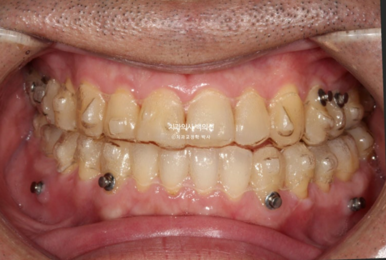 40대 인비절라인 비수술 비발치 주걱턱 비대칭 교정 관련 이미지 6