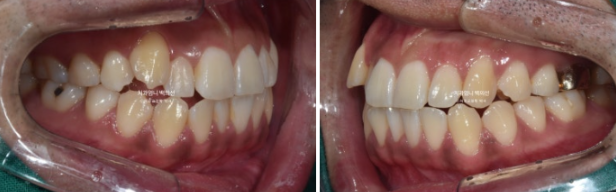 반대교합 비발치 교정 클리피씨 후기 관련 이미지 3