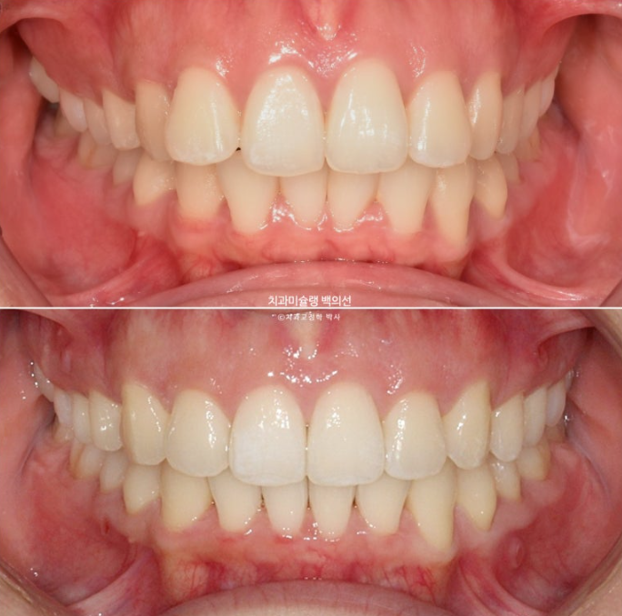 비발치 인비절라인 교정 돌출입 교정 후기 관련 이미지 18