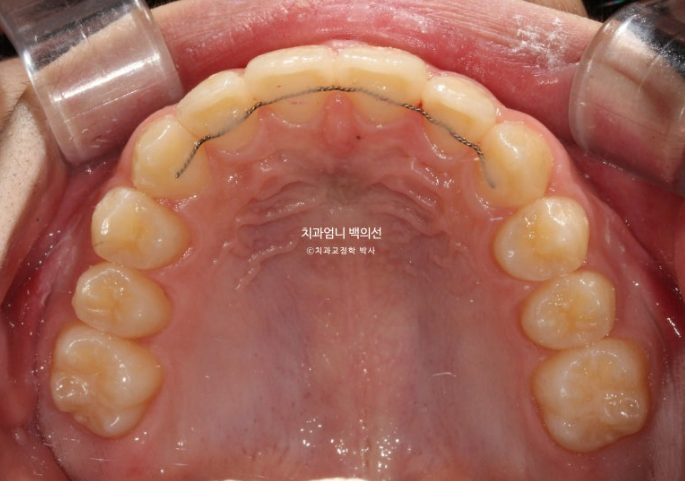 어린이 투명교정 인비절라인 퍼스트 가위교합 돌출교정 덧니교정 관련 이미지 10