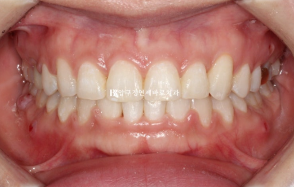 웃을 때 잇몸이 보여요. 잇몸미소 거미스마일 교정하기 관련 이미지 6