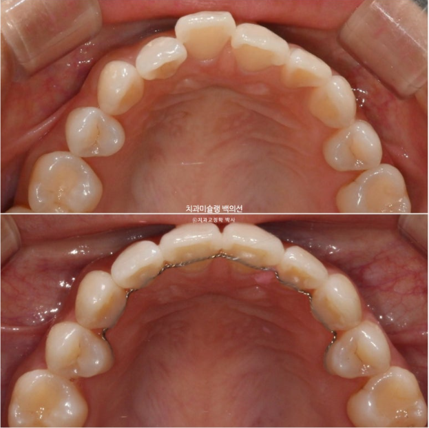 인비절라인 익스프레스 재교정 블랙트라이앵글 치간 삭제 치료기간 6개월 재제작 1회 관련 이미지 1