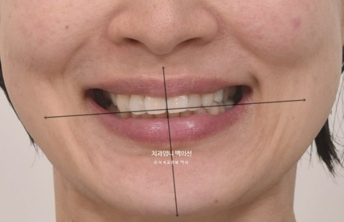 50대 치아교정 교합평면 기울어짐 토끼이 덧니 교정? 관련 이미지 2
