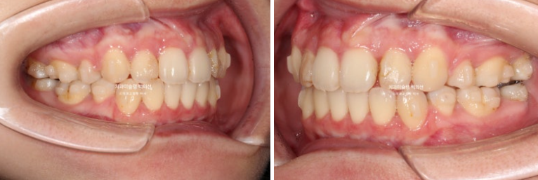 돌출입 인비절라인 발치교정 거미스마일 잇몸미소 잇몸돌출 입술부전증 무턱 재교정 관련 이미지 11