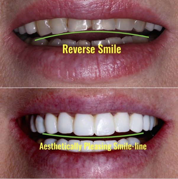Before and After Non-Prep Veneers: Improving Gaps Between the Front Teeth and the Smile Line Together image 4