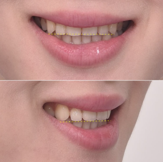 Non-Prep Veneer Review | A Case Naturally Improving Gaps Between the Front Teeth and the Smile Line image 5