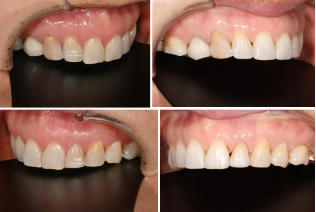 40대 무삭제 라미네이트 블랙트라이앵글 레진 치료 관련 이미지 4