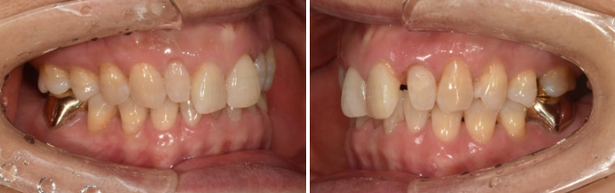 50s Invisalign Lite No-Prep Laminate Bunny Teeth image 3