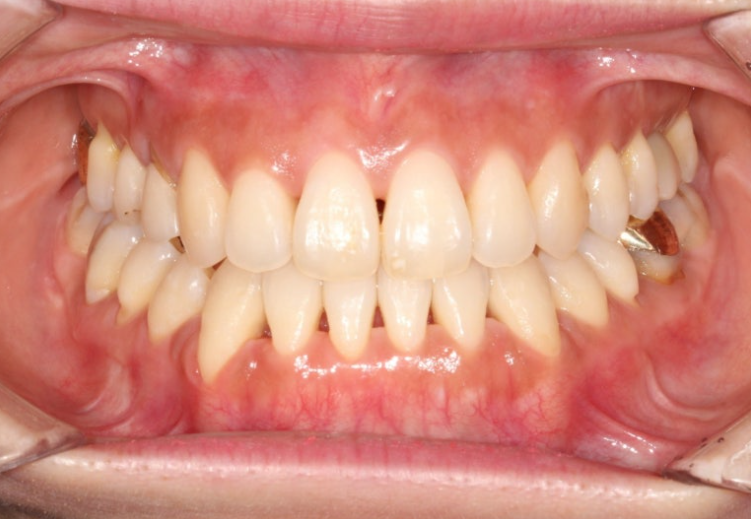 30대 비수술 비발치 주걱턱 부정교합 인비절라인 교정 관련 이미지 9