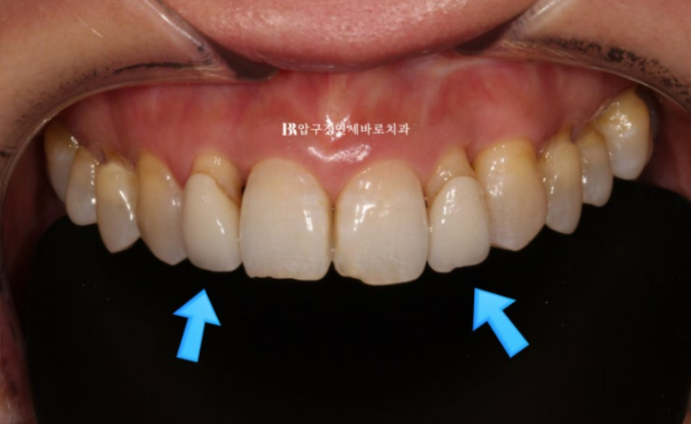 40대 오래된 크라운 교체 / 블랙트라이앵글 젤라미 치료 결과 관련 이미지 1