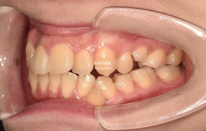 30대 인비절라인 덧니 발치교정 개방교합 치료 관련 이미지 4