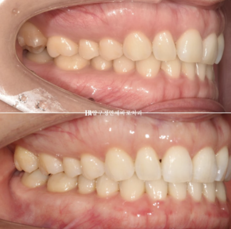 인비절라인 라이트 가위교합 치아 벌어짐 치료 관련 이미지 10