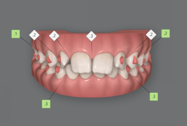 인비절라인라이트 덧니 과개교합 교정 치료기간 9개월 관련 이미지 3