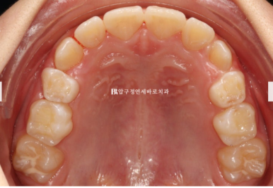 소아 투명교정 인비절라인 퍼스트 후기 기록 관련 이미지 14