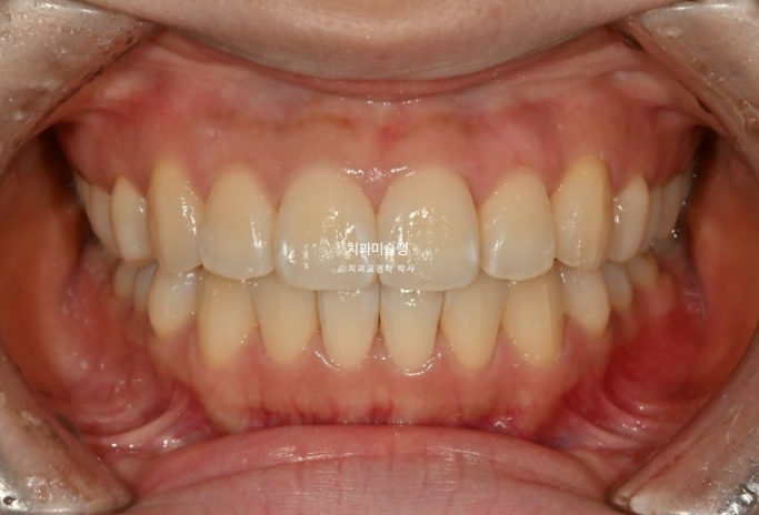 인비절라인 라이트 반대교합? 덧니 중심선 치간삭제 치료 관련 이미지 11