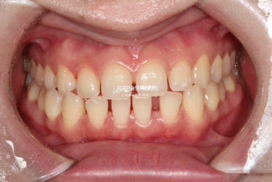 앞니 벌어짐 합죽이 방지 교정 기간 1년 4개월 관련 이미지 1