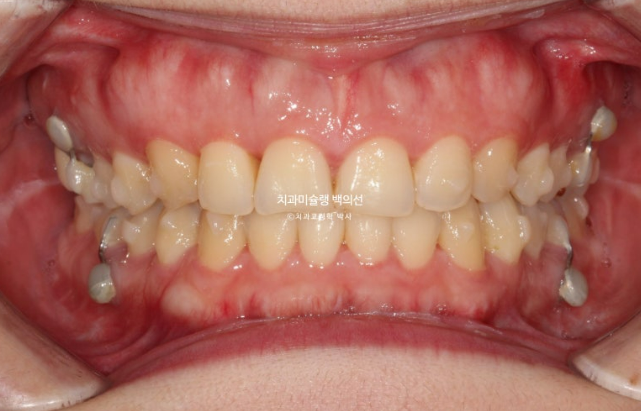 비발치 덧니 교정 인비절라인 과개교합 교정 무삭제 라미네이트 치료 후기 관련 이미지 7