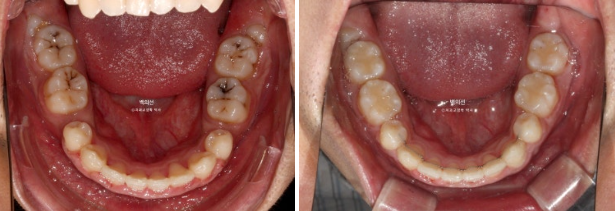 거미스마일 잇몸미소 발치 돌출입 과개교합 교정 후기 관련 이미지 12