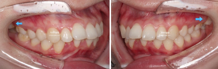 심한 돌출입 입술부전증 호두주름 발치교정 치료 관련 이미지 3
