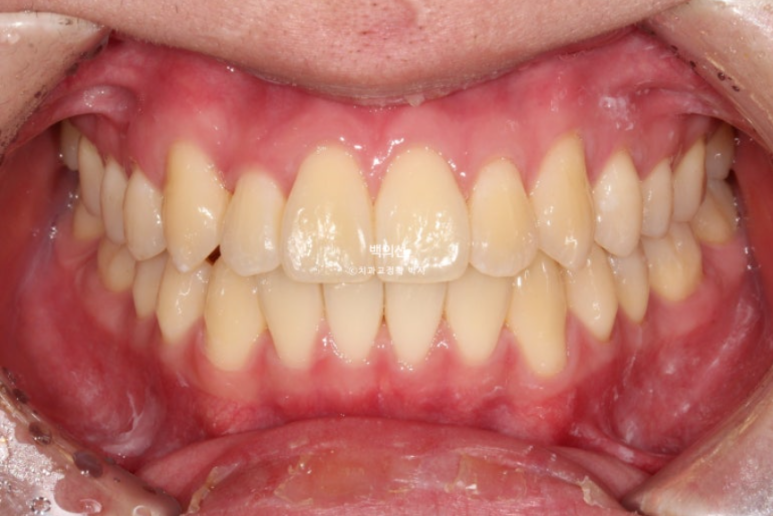 유학생 교정 덧니 반대교합 인비절라인 라이트 치료기간 관련 이미지 11