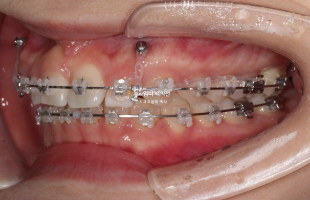 거미스마일 과개교합 교정 잇몸돌출 잇몸 비대칭 관련 이미지 6