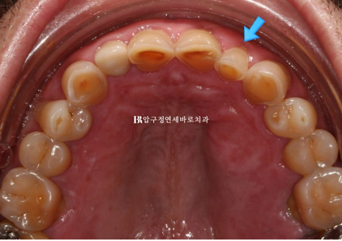 50대 중년교정 무삭제 라미네이트 중년 부분교정 후기 관련 이미지 4