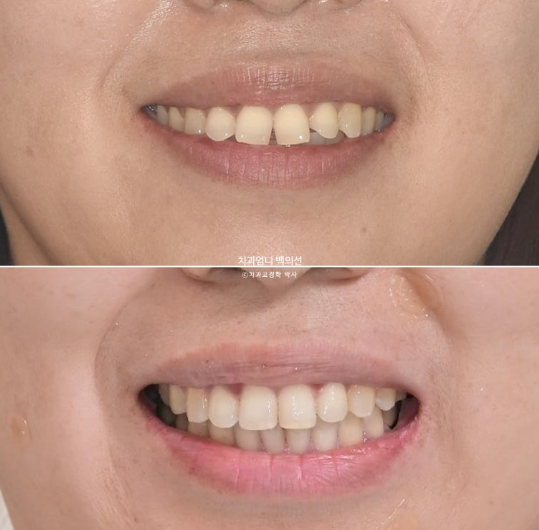 40대 인비절라인 라이트 앞니 벌어짐 뻗침 돌출 치료 관련 이미지 20