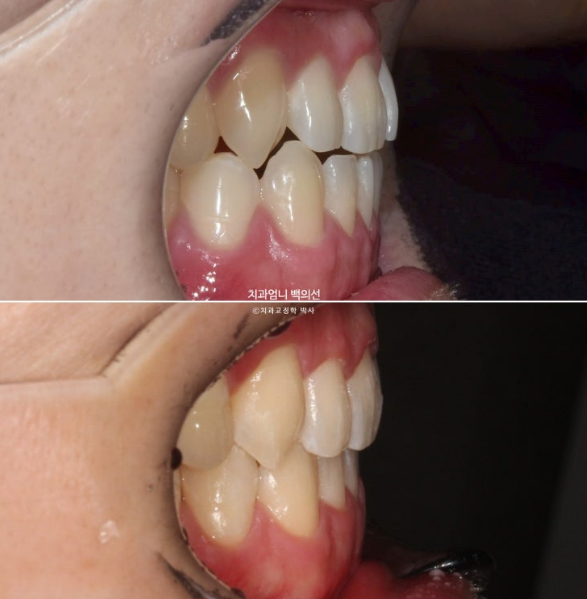 MSE Palatal Expansion Invisalign Underbite Correction, Non-Surgical image 23