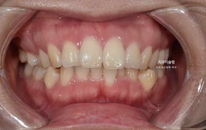 돌출입 덧니 발치 교정 인비절라인 교정 후기 관련 이미지 2